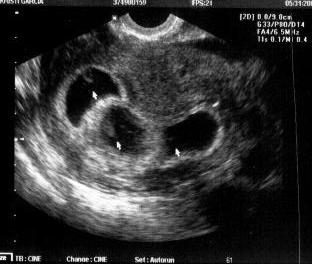 16 week ultrasound   triplets